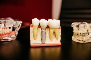 Kenali Jenis Implan Gigi yang Tersedia di Klinik Gigi Yogyakarta